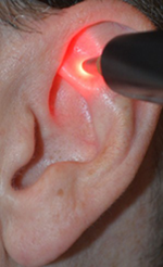 ear_laser